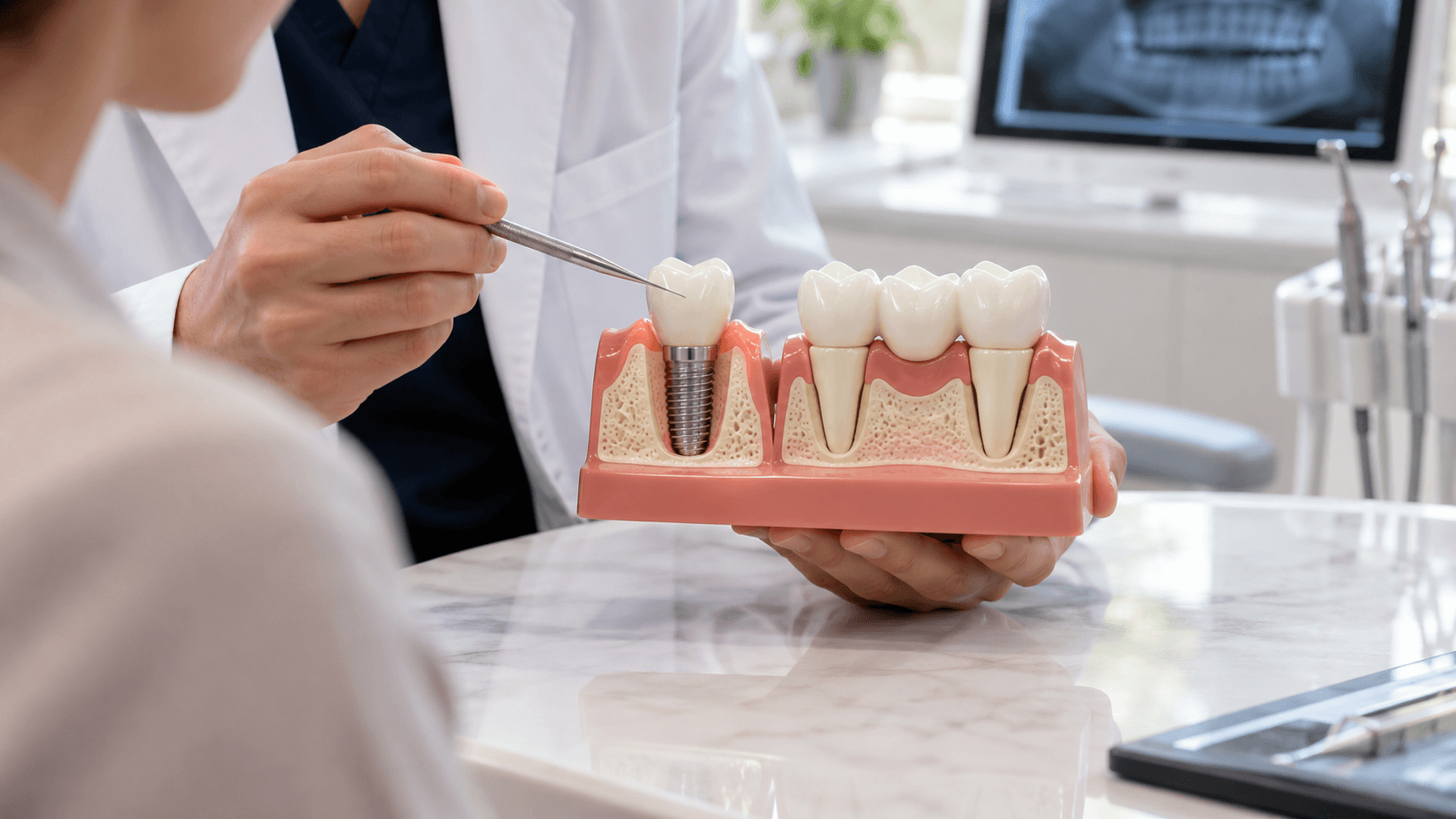 Comparativa de implante dental y puente fijo para sustituir un diente perdido
